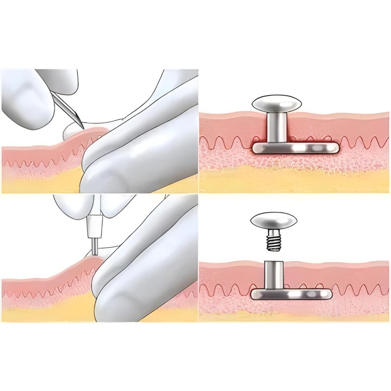 AccGin Disposable Biopsy Punch Sterile Biopsy Dermal Punch for Piercing,