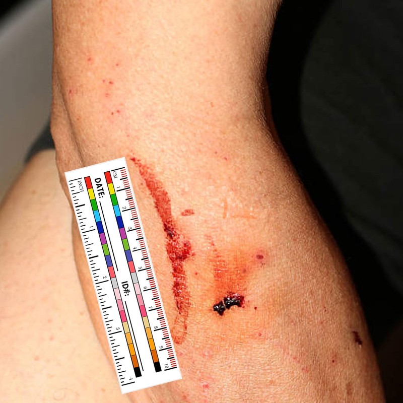 Self-Adhesive Wound Measurement Tools Sticker 100 pcs Wound Measuring Ruler