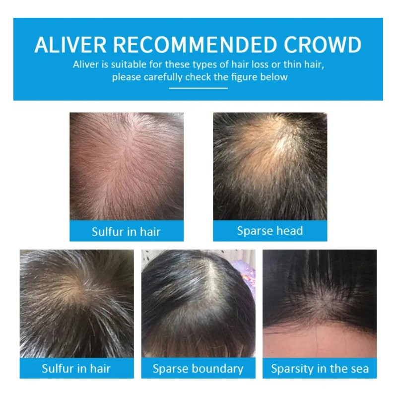 Fibras Capilares Con Queratina Disimula Calvicie Entradas