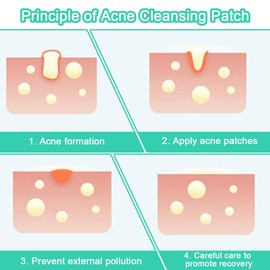 OUDQFCJ 100 Stück Pimple Patch Hydrokolloid Pflaster Unsichtbare Natürliche Mit Salicylsäure Und Teebaumöl Tag Und Nacht 2-In-1 Anti Pickel Patches Wasserdicht Atmungsaktiv Absorptions (Acne)