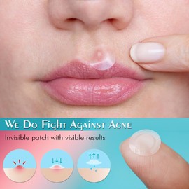 Exsivia Acne Pimple Patches, Ultra Thin Gentle Blemish & Zit Covers, Natural and optimal Healing, Suitable for All Skin Types, 96 Hydrocolloid Patches