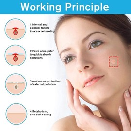 Acne Pimple Master Patches Spot & Blemish Treatment Stickers Invisible Hydrocolloid Patches (360P)