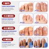 Fungal Nail Patches,32PCS Fungal Nail Patches for Toenails,Nail Repair for
