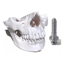 MiniMex 3D Modelo Anatómico Mandíbula 1:1 Y Mini-implante Impresos 3d