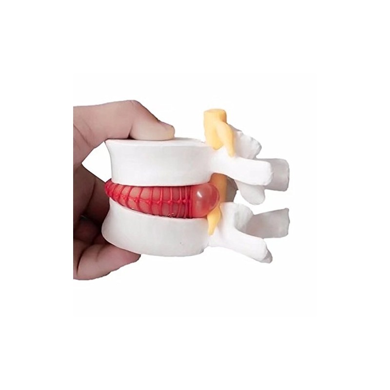 BoNew 1:1.5 Anatomical Human Lumbar Vertebrae Degenerative Lumbar Human Spine