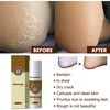 YG LianKai 3Pcs Feet Spray, Athlete's Foot Spray,Herbal Foot Peeling