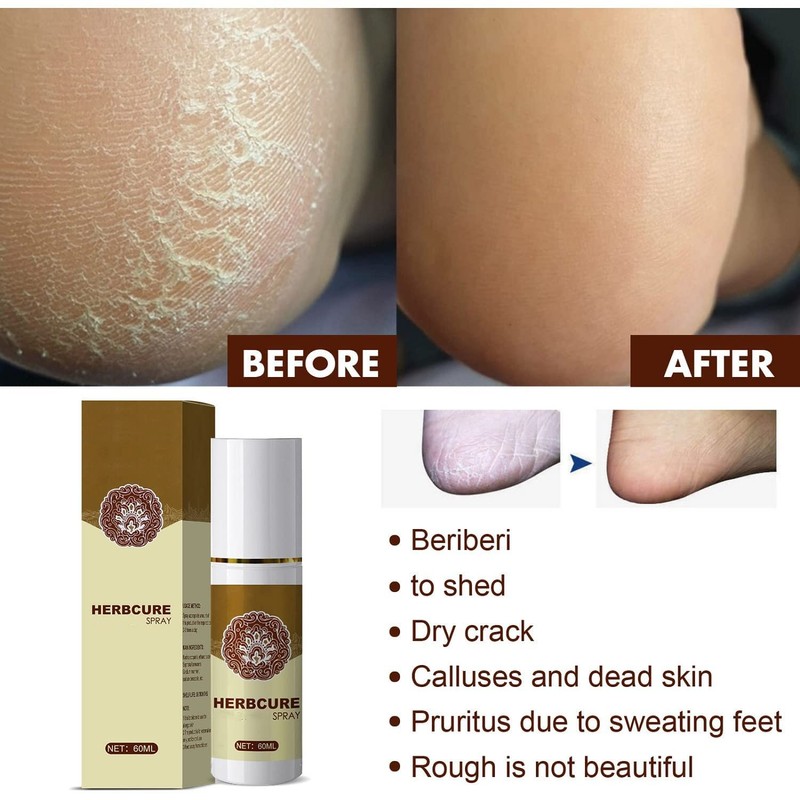 YG LianKai 3Pcs Feet Spray, Athlete's Foot Spray,Herbal Foot Peeling