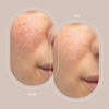 Trophy Skin Pore Injection Tips - Compatible with all microdermabrasion