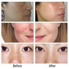 Handheald Red Light Picosecond Laser Pen Scar Tattoo Removal Melanin