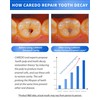 CAREDO Cavity Repair Toothpaste Set for Adults, 16g Pulpitis Ointment