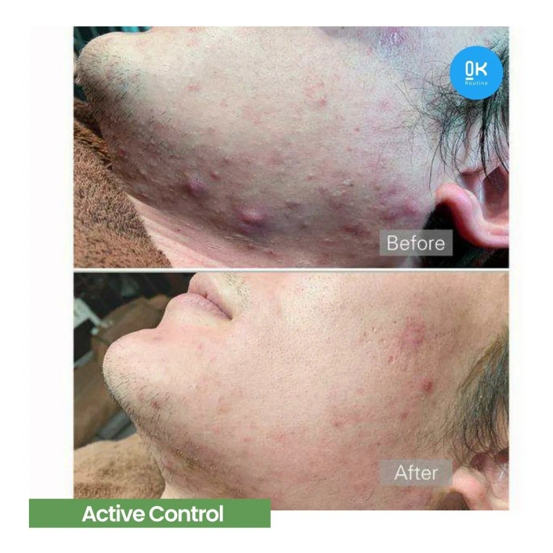 Hidratante Piel Grasa/acné Hubislab Active Control 120ml.