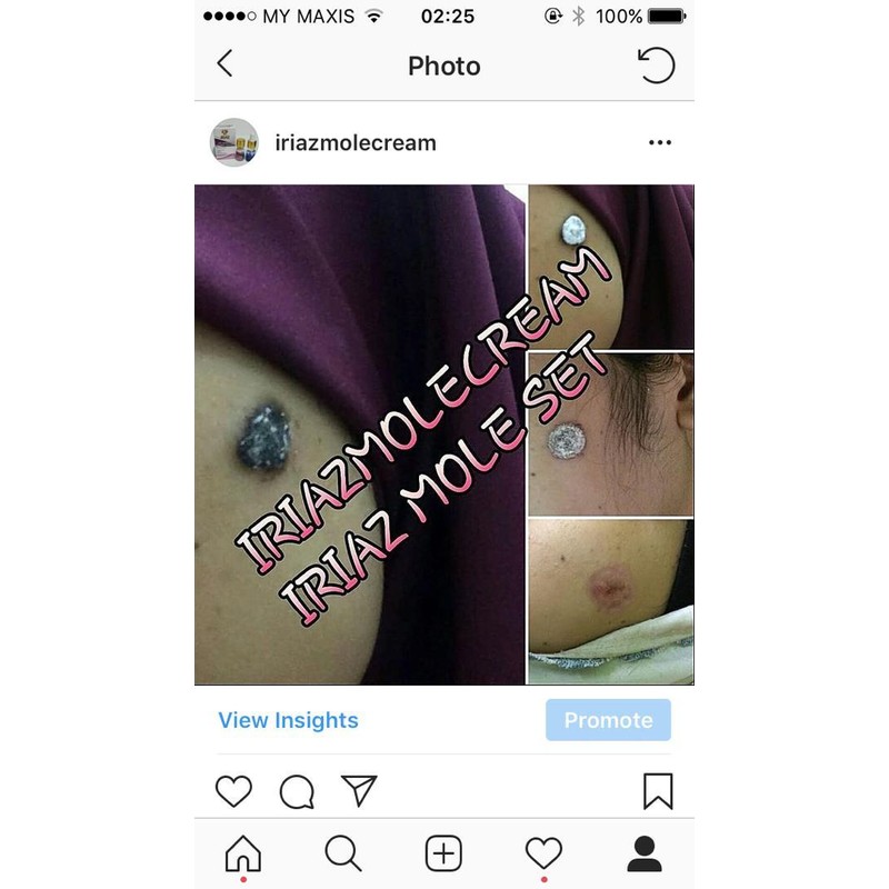 IRIAZ MOLE CREAM BUANG TAHI LALAT KUTIL BIJI KOLESTEROL