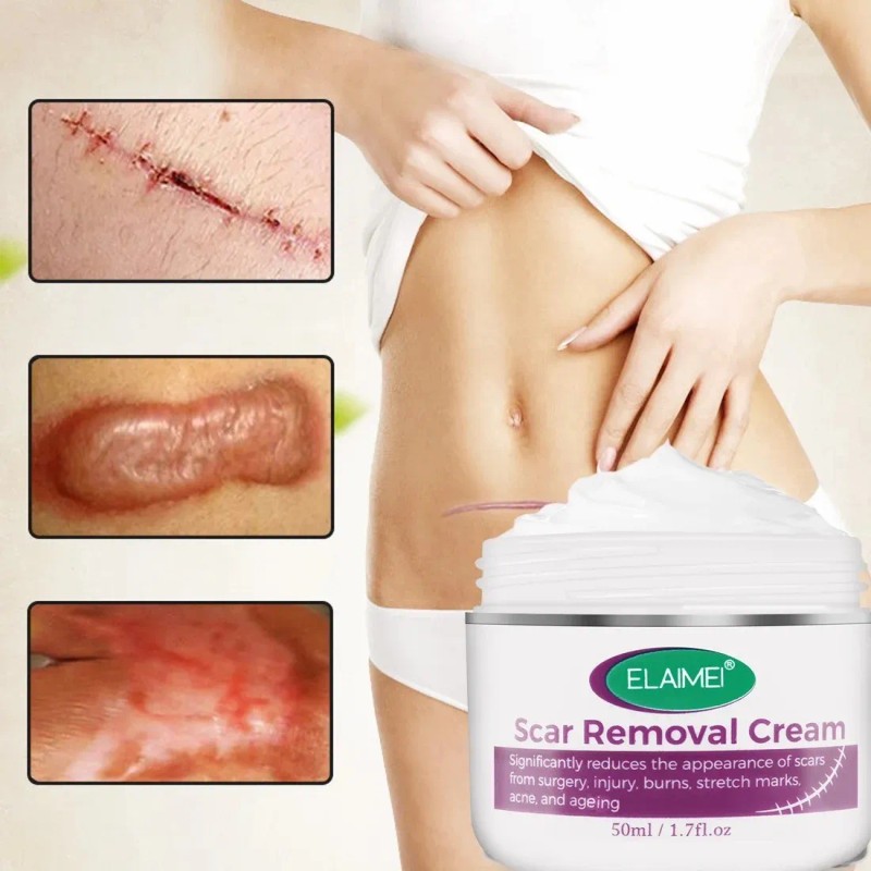 Crema Desvanece Cicatrices Queloides Acné Cacarizos Estrias Momento De Aplicación