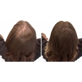 Blackbeard Scalpixyl 10% Crecimiento Anticaída Cabello 30 Ml