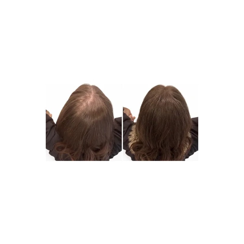 Blackbeard Scalpixyl 10% Crecimiento Anticaída Cabello 30 Ml