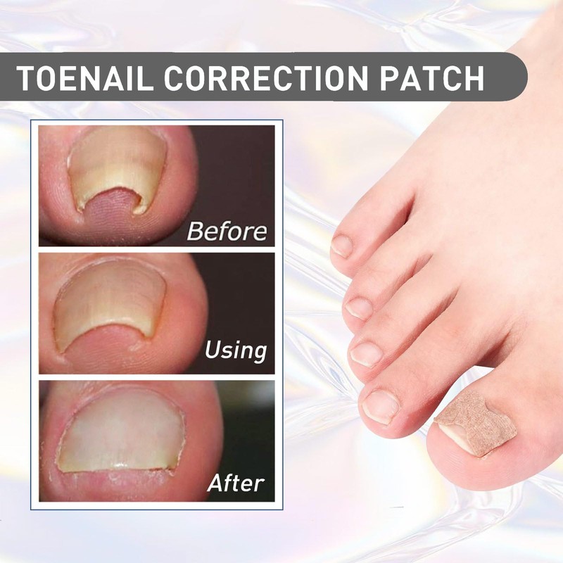 MFCGHXR Ingrown Toenails Tool Set 124 Pieces Toenail Correction Patch,