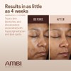 Ambi Even Clear Advanced Fade Cream, Hydroquinone-free, Hyperpigmentation Treatment, Stubborn