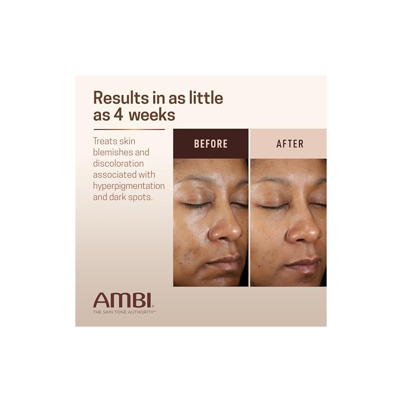 Ambi Even Clear Advanced Fade Cream, Hydroquinone-free, Hyperpigmentation Treatment, Stubborn