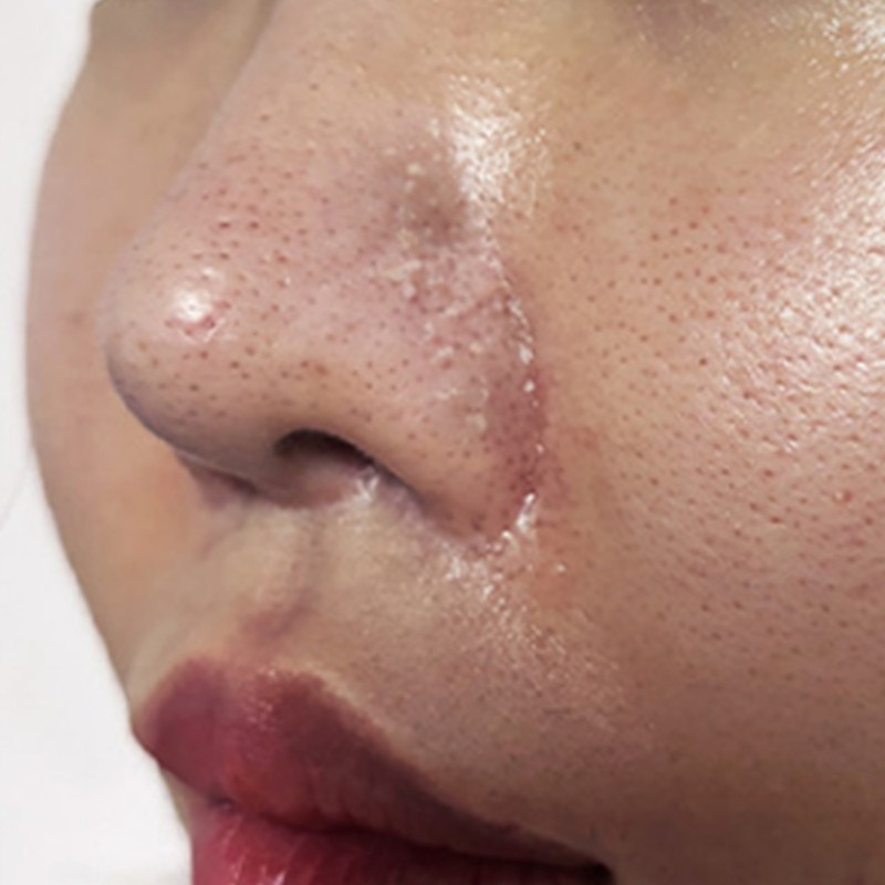 [Dermatology branch] Nose sebum softener ampoule dermatology peeling exfoliation /