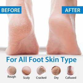 Crema Para Pies Con Urea Al 40%, Urea Al 40% Y Ácido Salicílico Al 2%, Crema Para Pies Y Manos Con Aceite De Cocos Nucifera, Árbol De Té, Aloe Vera Y Vitamina E (150 G)