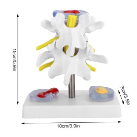 Anatomical Lumbar Disc Herniation Model Human Spine Training Supplies d3e2