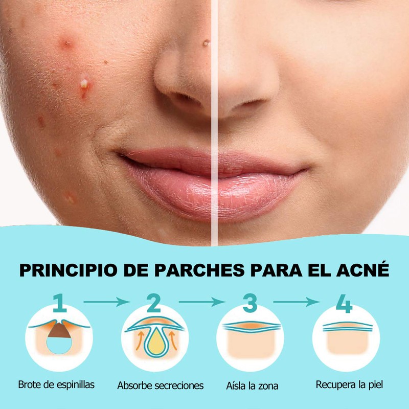 Parches para Acne,Pimple Patch, Parches para Espinillas, Almohadillas Hidrocoloides para