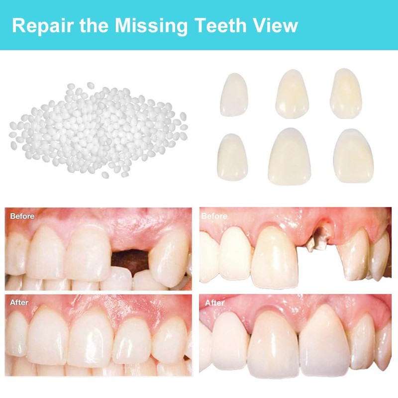 Brige Tooth Repair kit for Filling The Missing Broken Tooth