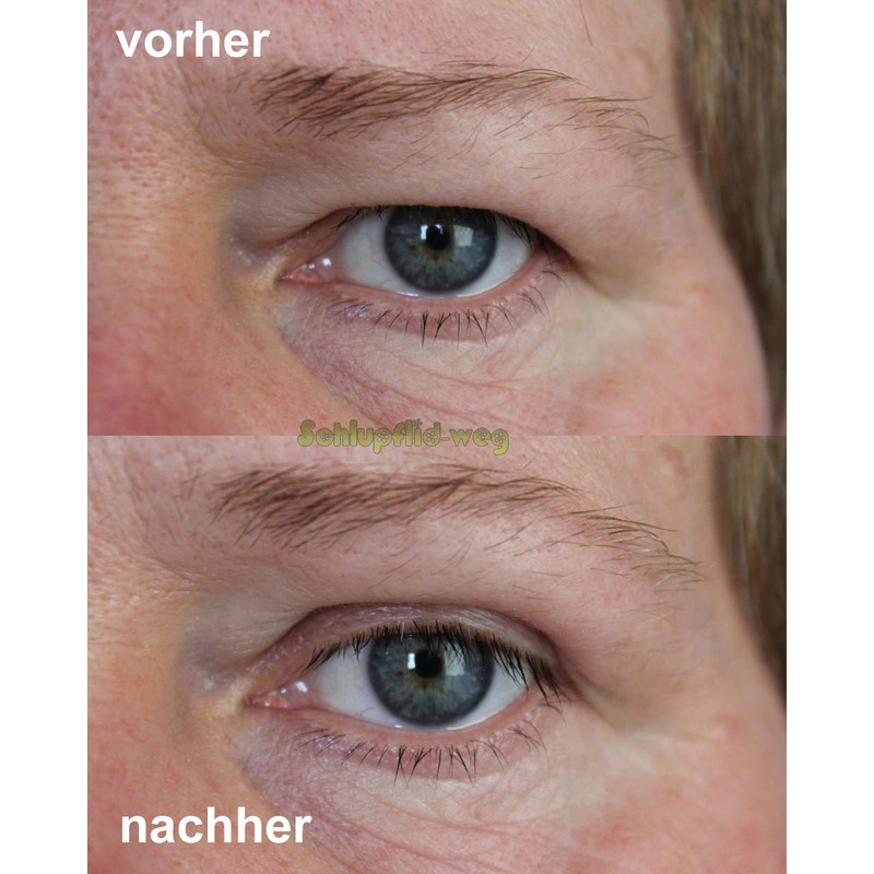 Magic Invisible "Pretty Size" (M) Eyelid Lift Without Surgery [2