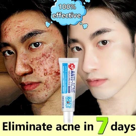 No Brand Real and effective Acne Pimple Cream 祛痘膏祛痘乳霜 20g Natural Face Creams Moisturizer Acne Treatment Gel for Skin Repairing