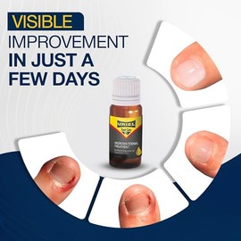 URIEL- Tratamiento mejorado para uñas encarnadas, kit para eliminar uñas encarnadas, corrector para uñas encarnadas, uñas encarnadas