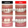 Dental Temporary Tooth Cap Crown Veneers Front Back Anterior and