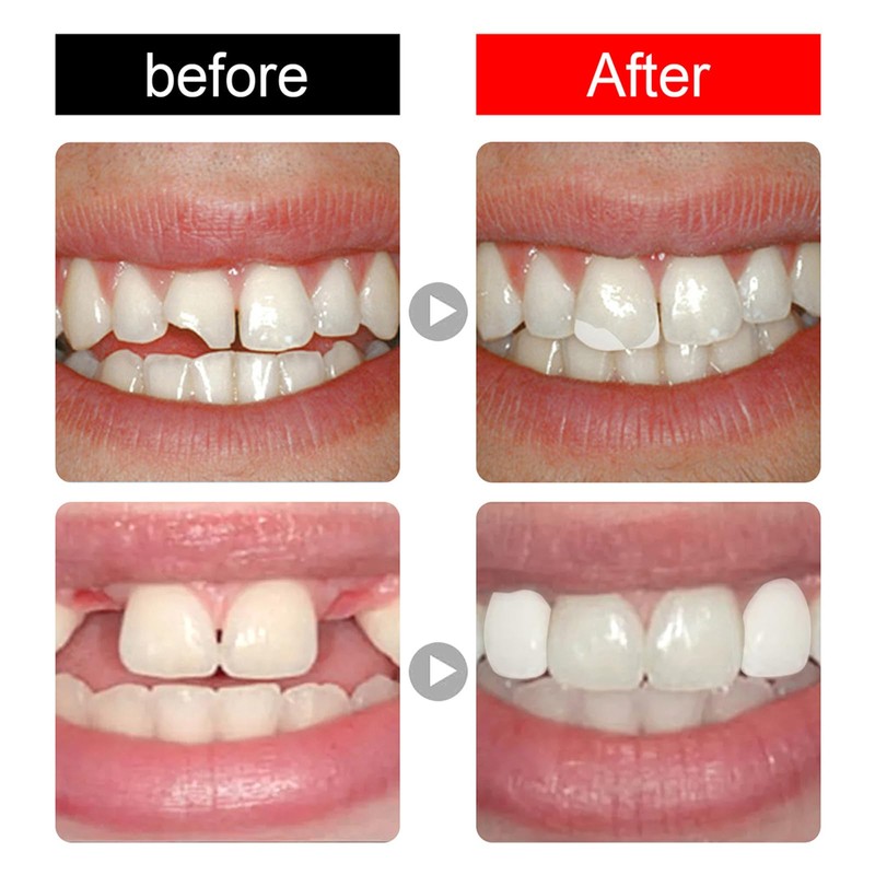 Dental Temporary Tooth Cap Crown Veneers Front Back Anterior and