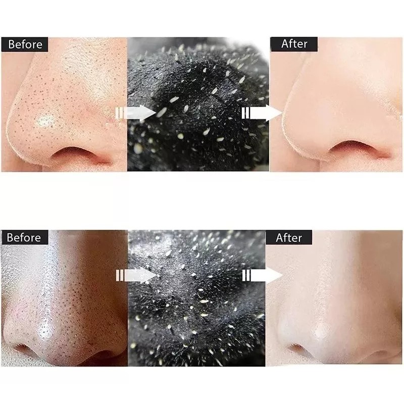 Molin 15 Sobres Removedores De Puntos Negros Mascarilla Black