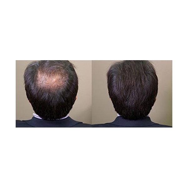 Hair Fusion Fibers 28g/.98oz Dark Brown - Thickens Balding or Thin Hair