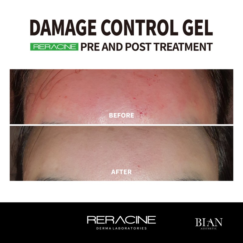 Lyricin Lyracin Damage Control Gel 200ml / 리라신 데미지컨트롤 겔