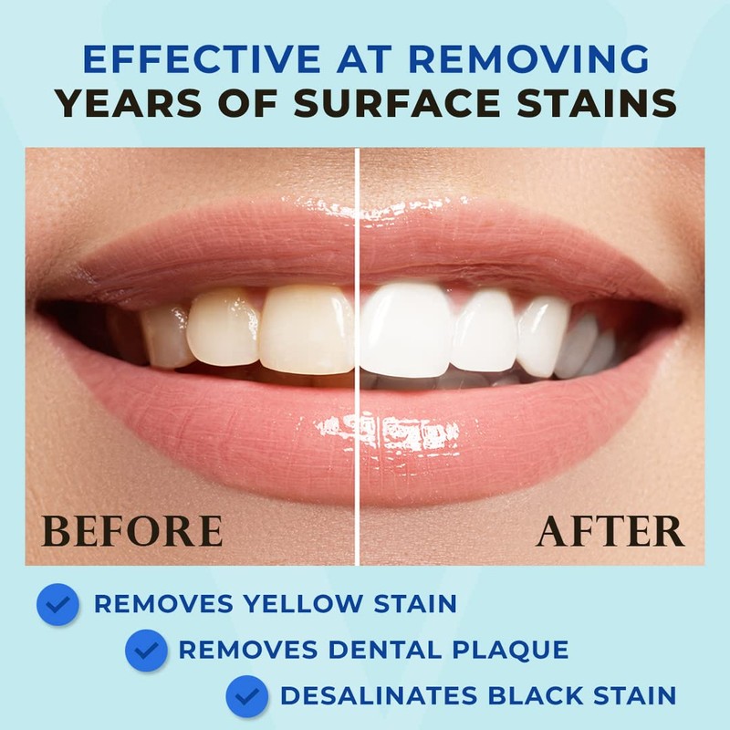 Venus Visage Award Winning Teeth Whitening Pen, 20+ Uses -