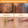 NuDerma Skin Therapy Wand - Portable Handheld High Frequency Skin