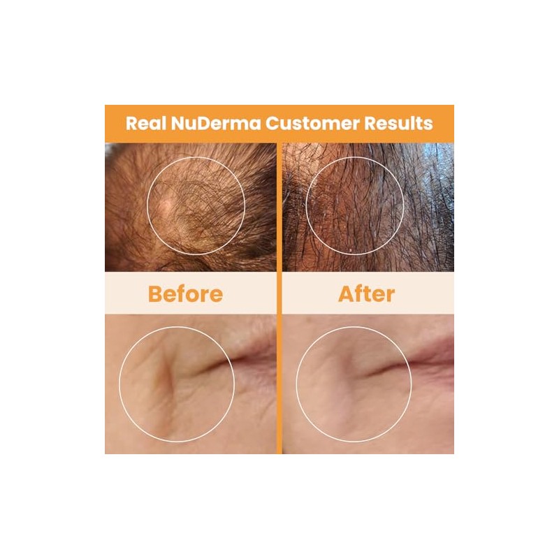 NuDerma Skin Therapy Wand - Portable Handheld High Frequency Skin