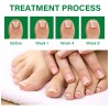 3pcs Suero Uñas Jengibre Cuidado Mopoyat