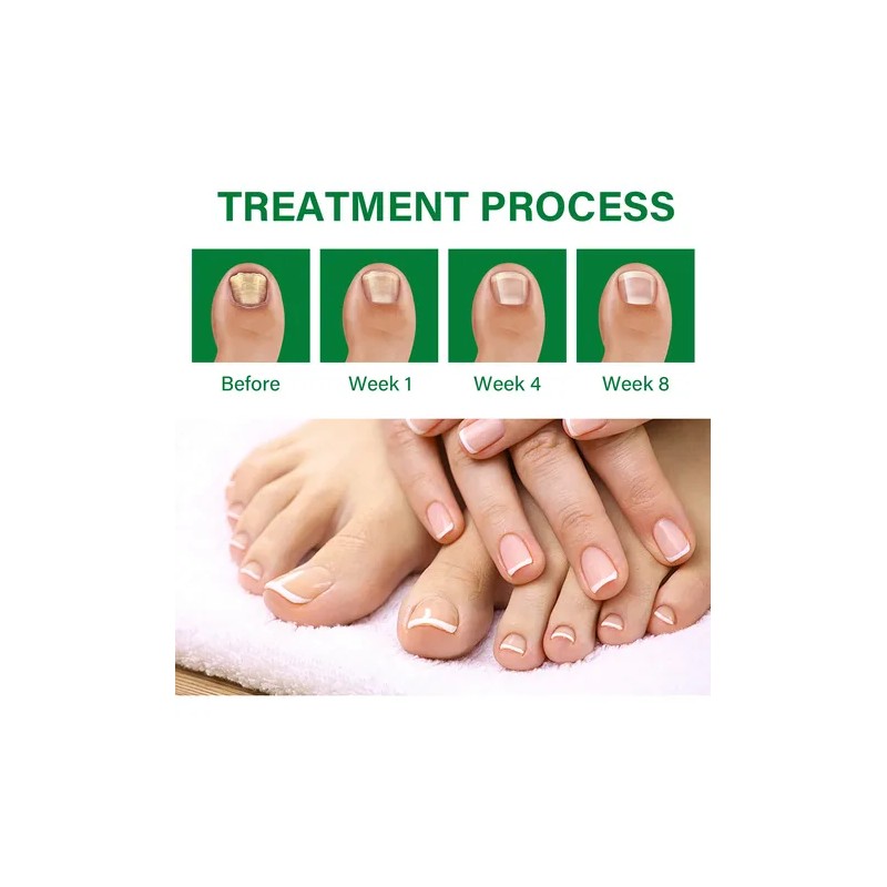 3pcs Suero Uñas Jengibre Cuidado Mopoyat