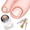 2 Piece Set Ingrown Toenail Correction Strips Brace Kit Ingrown