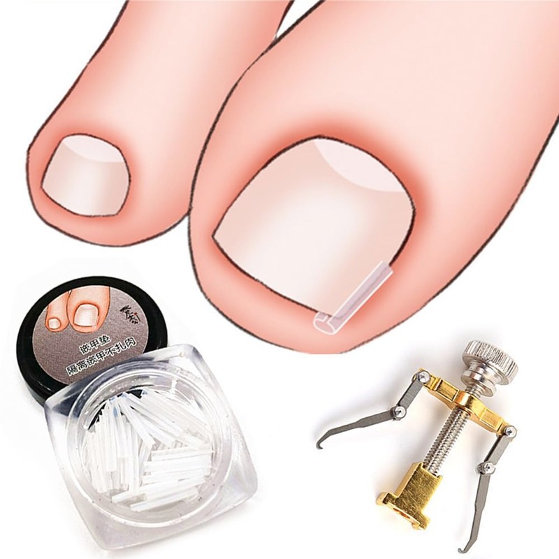 2 Piece Set Ingrown Toenail Correction Strips Brace Kit Ingrown