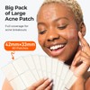 Large Pimple Patches (5 Sizes, 92 Patches), Hydrocolloid Acne Patches,