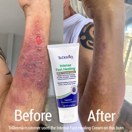 TriDerma Intense Fast Skin Healing Cream for Hard-to-Heal Skin Irritations, Sores, Rashes, Dry, Cracked Hands, Cuts, Chafing, Burns, Scrapes - First Aid Kit Essential - FSA Eligible - 2.2 oz Tube