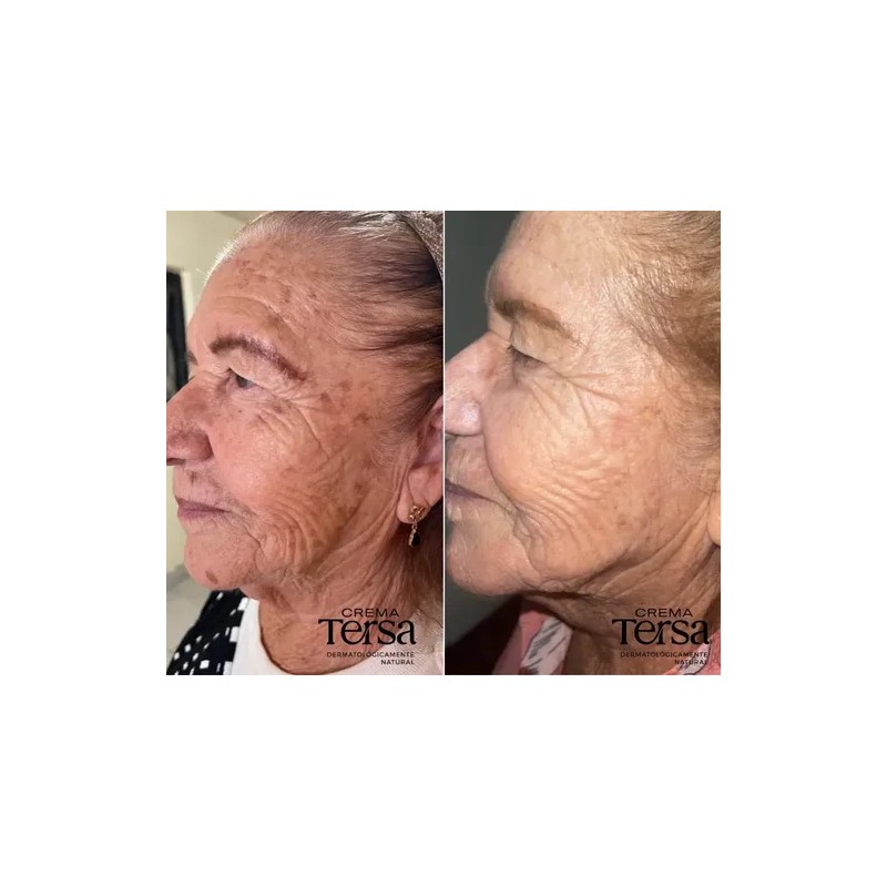 Crema Tersa Despigmentante Quita Manchas Acné Paño De 40g