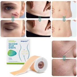 Parches de Silicona para Cicatrices, Láminas de Silicona Reutilizables para Reducir la Apariencia de Cicatrices, Cesárea, Cirugía, Acné y Estrías, Sua