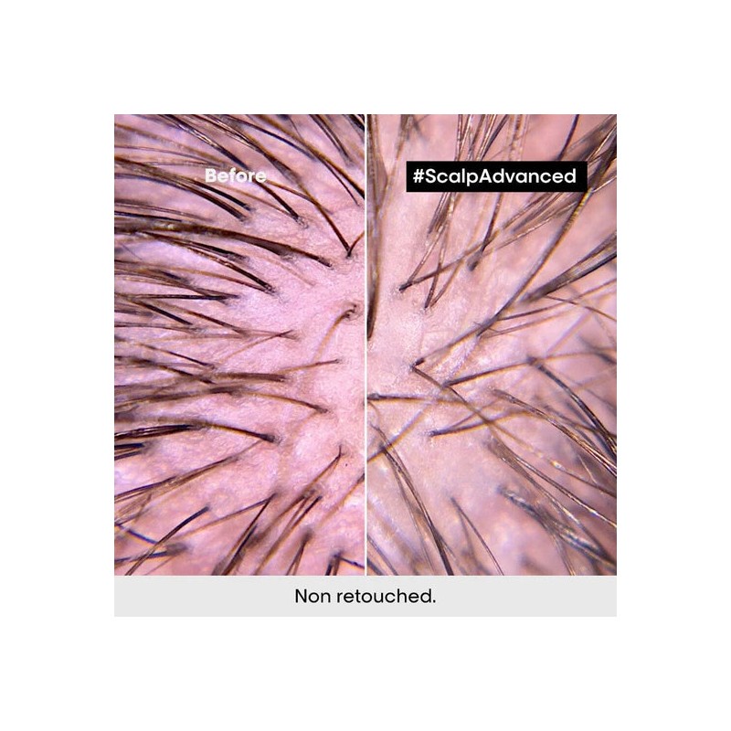 L'Oréal Professionnel Scalp Advanced Anti-Discomfort Duo Bundle