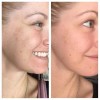 Niacinamide 10% +Zink 1% +Hyaluronic Acid | Acne/Blemish/Oil Control Serum/Cream