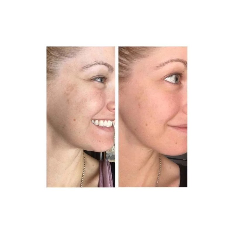 Niacinamide 10% +Zink 1% +Hyaluronic Acid | Acne/Blemish/Oil Control Serum/Cream