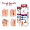 Crema Fúngica Para Uñas,eliminación Hongo De La Uña 20g